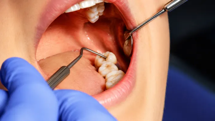 Wisdom Tooth Extraction