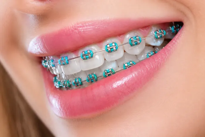 Braces