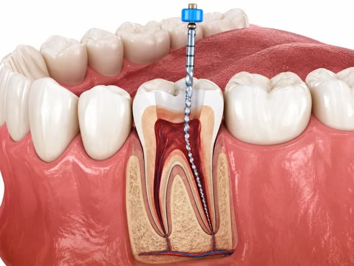 Root Canal Treatment