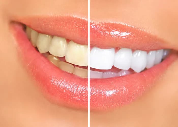 Teeth Whitening
