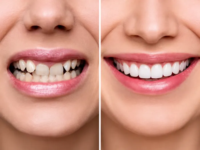 Smile Makeover